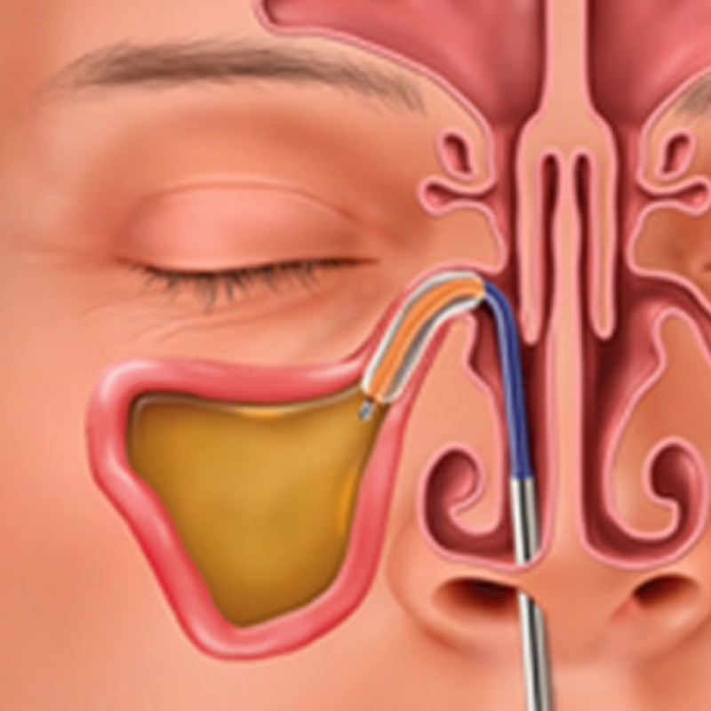 Balloon Sinuplasty